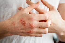 Contro prurito e lesioni, ok Aifa a nuova cura per dermatite atopica