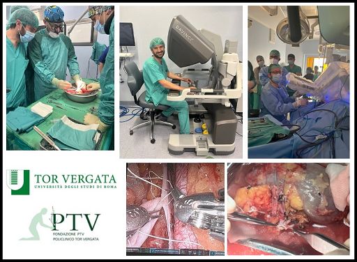 Al Policlinico Tor Vergata autotrapianto di rene con tecnica robotica